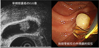 左：早期胆嚢癌のEUS像、右：総胆管結石の内視鏡的採石