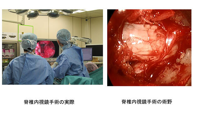 脊椎内視鏡手術の実際と脊椎内視鏡手術の術野