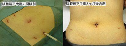 左：腹腔鏡下手術の開腹創、中央：腹腔鏡下手術3ヶ月後の創、右：SILS（単孔式内視鏡下手術）3ヶ月後の創