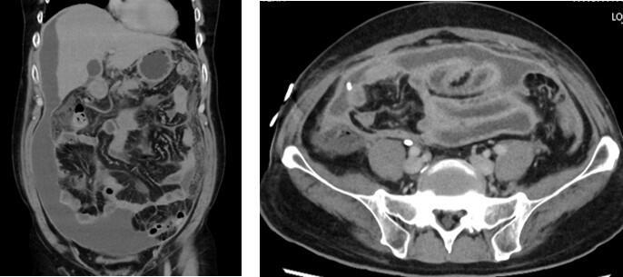 結核性腹膜炎に伴う腹膜硬化症の例.jpg