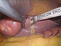 図1 腹腔鏡下肝切除術