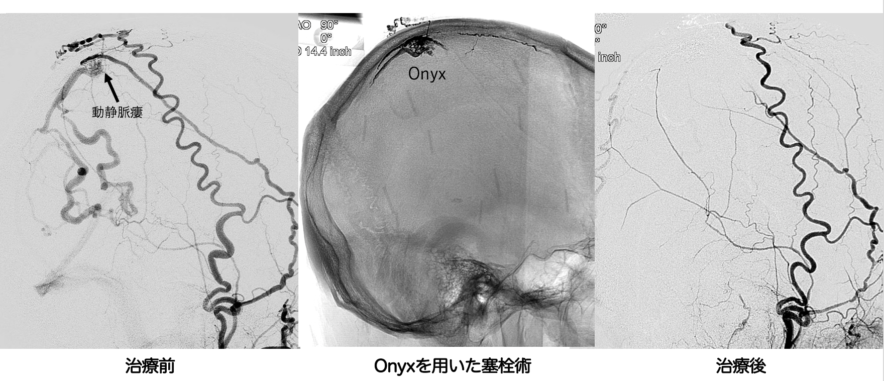 脳インプラントはてんかん、関節炎、あるいは失禁さえも治療できるのでしょうか?